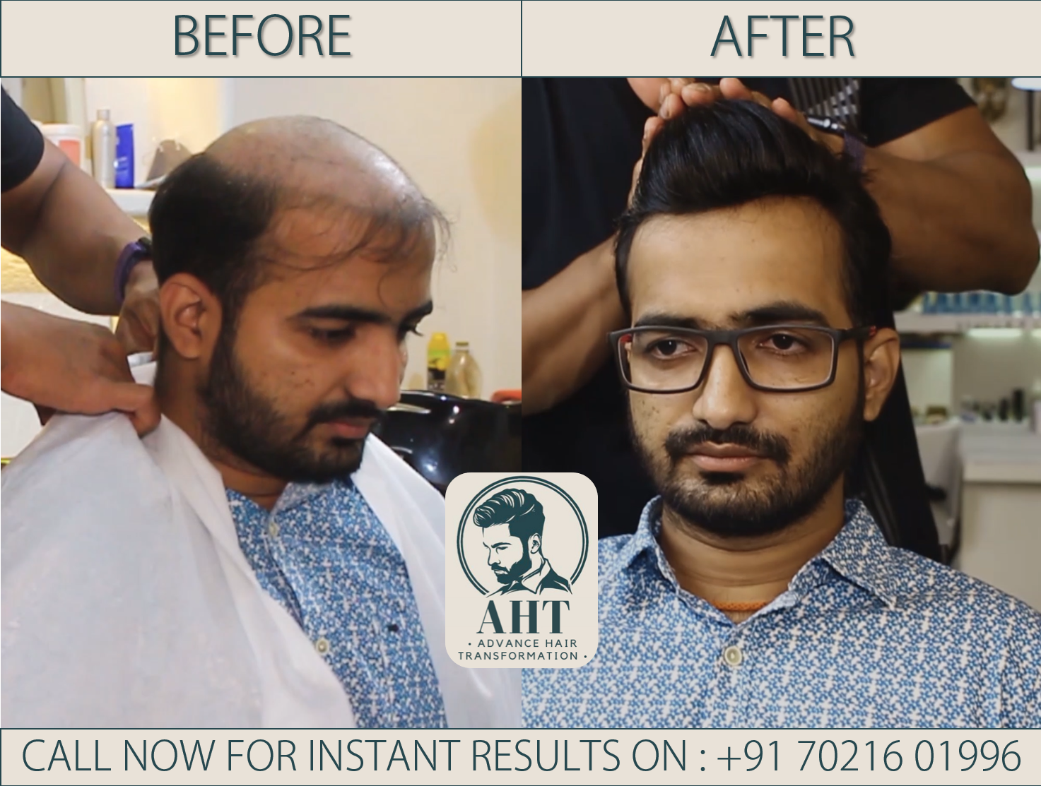 Hair Restoration results