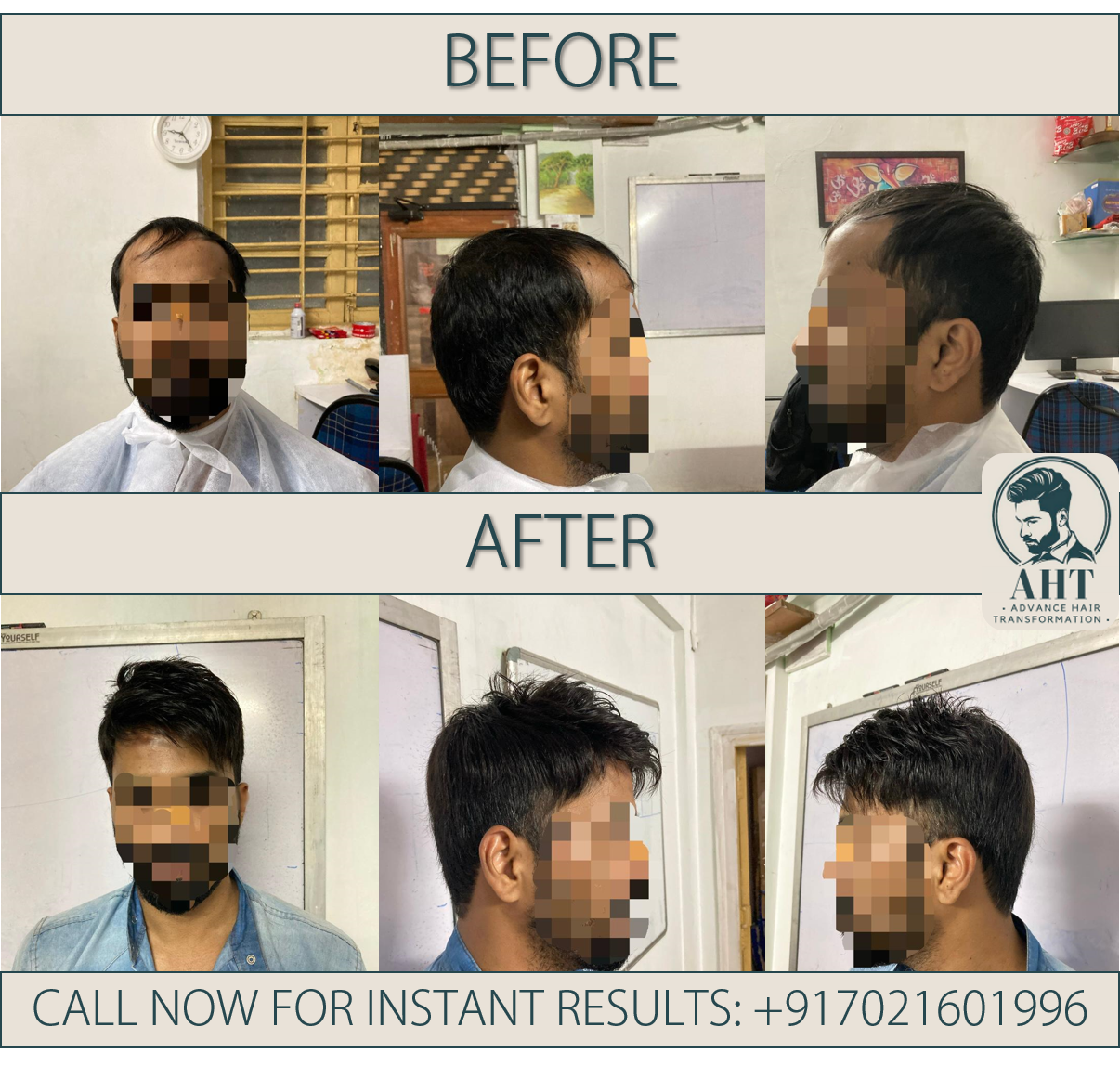 MaxHair  Best Hair Transplant Clinic in India