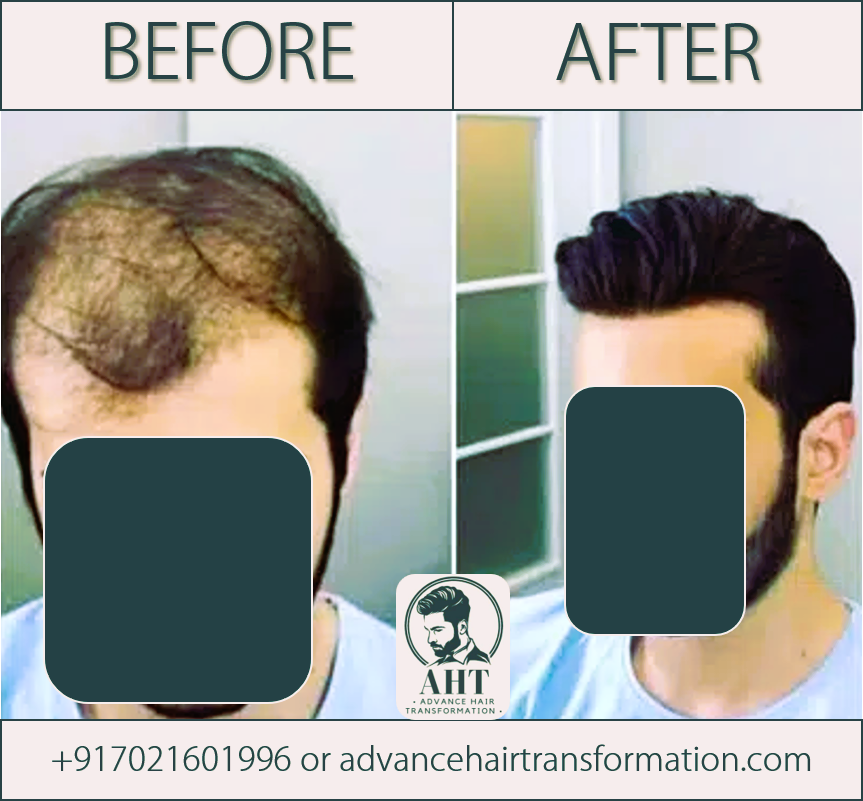 Best Hair Replacement Company in Mumbai