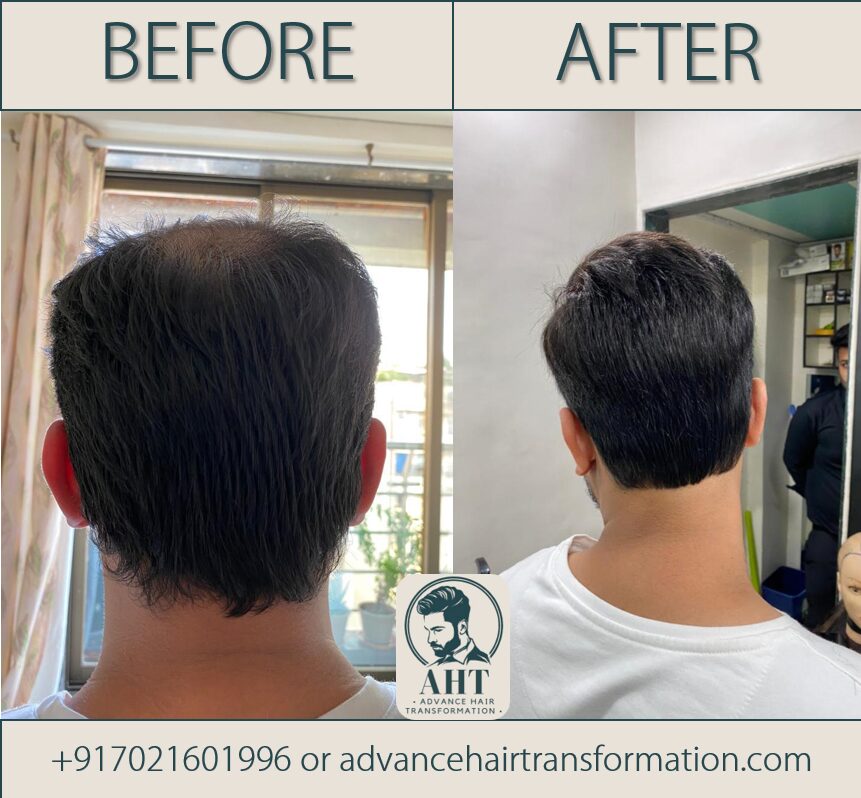 Non-Surgical hair solutions in Mumbai,India